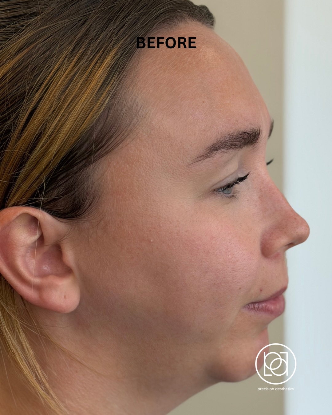 Before treatment photograph from the original facial-balancing case