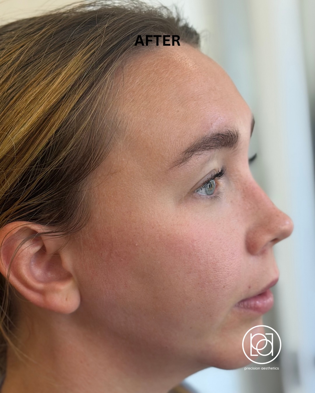 After treatment photograph from the original facial-balancing case