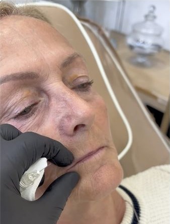 Mature lip enhancement: subtle shape and gradual treatment