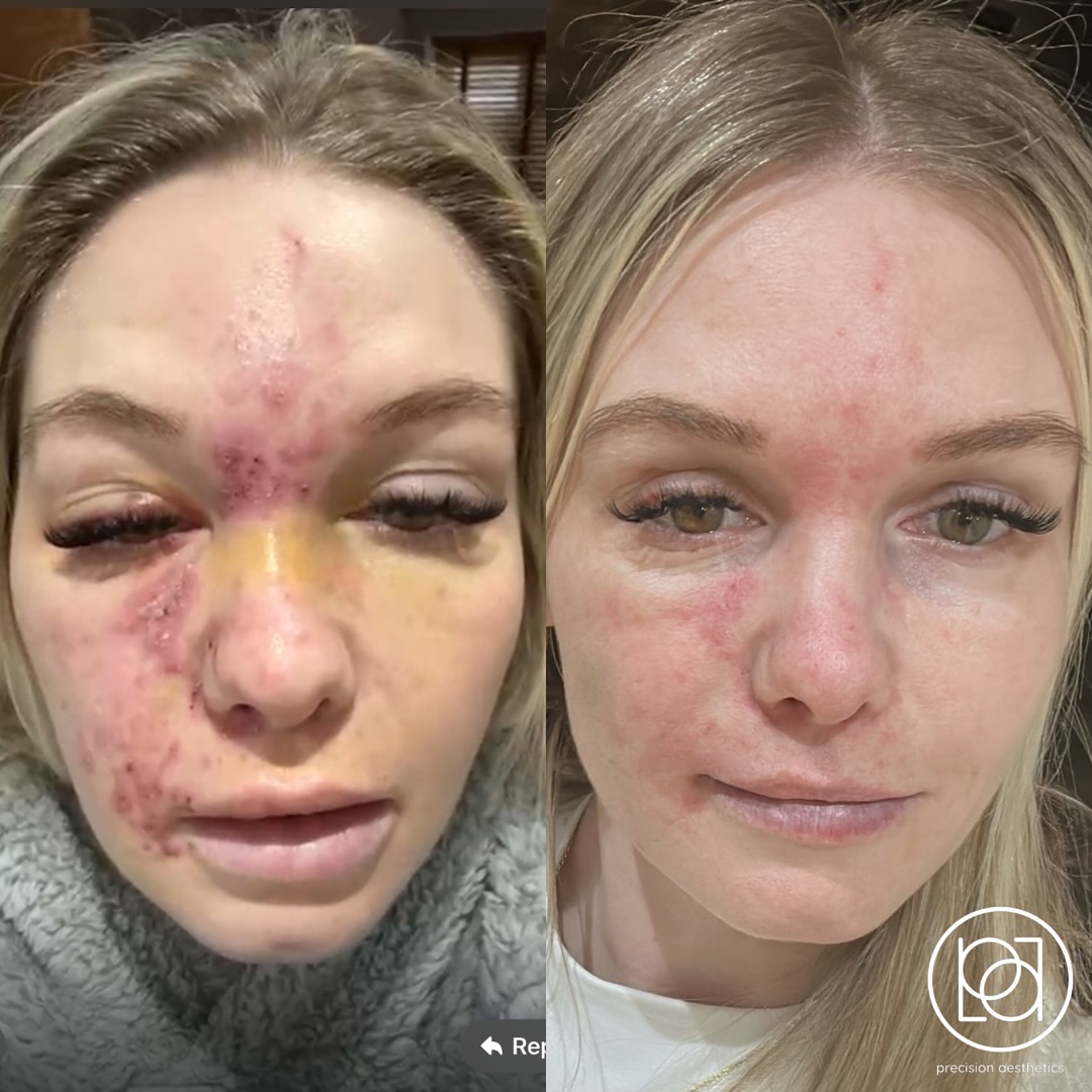 Original Precision Aesthetics comparison showing facial vascular occlusion and subsequent recovery